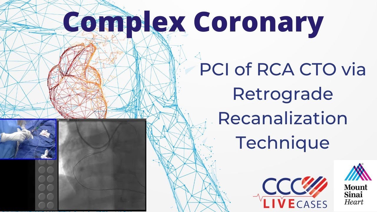 PCI of RCA CTO via Retrograde Recanilization Technique - CCC Live Sept 2016