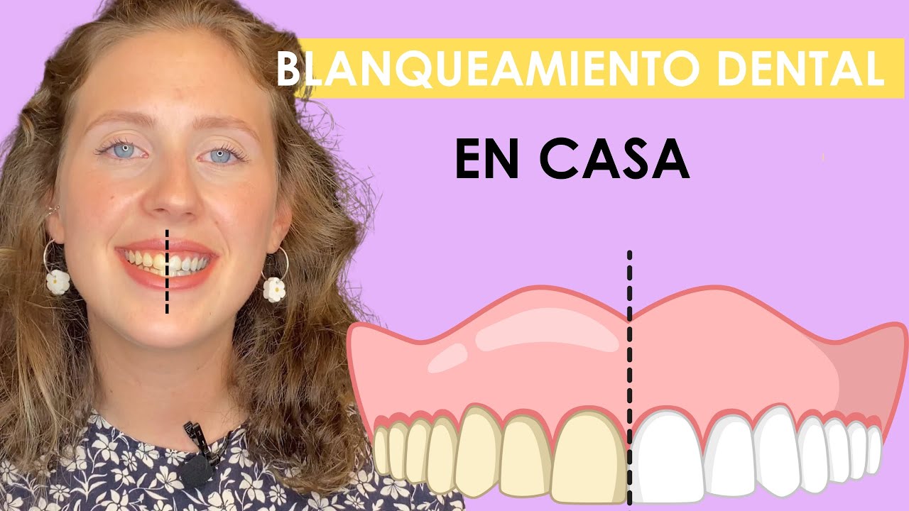Blanqueamiento dental en casa con fundas | Dentista te lo explica