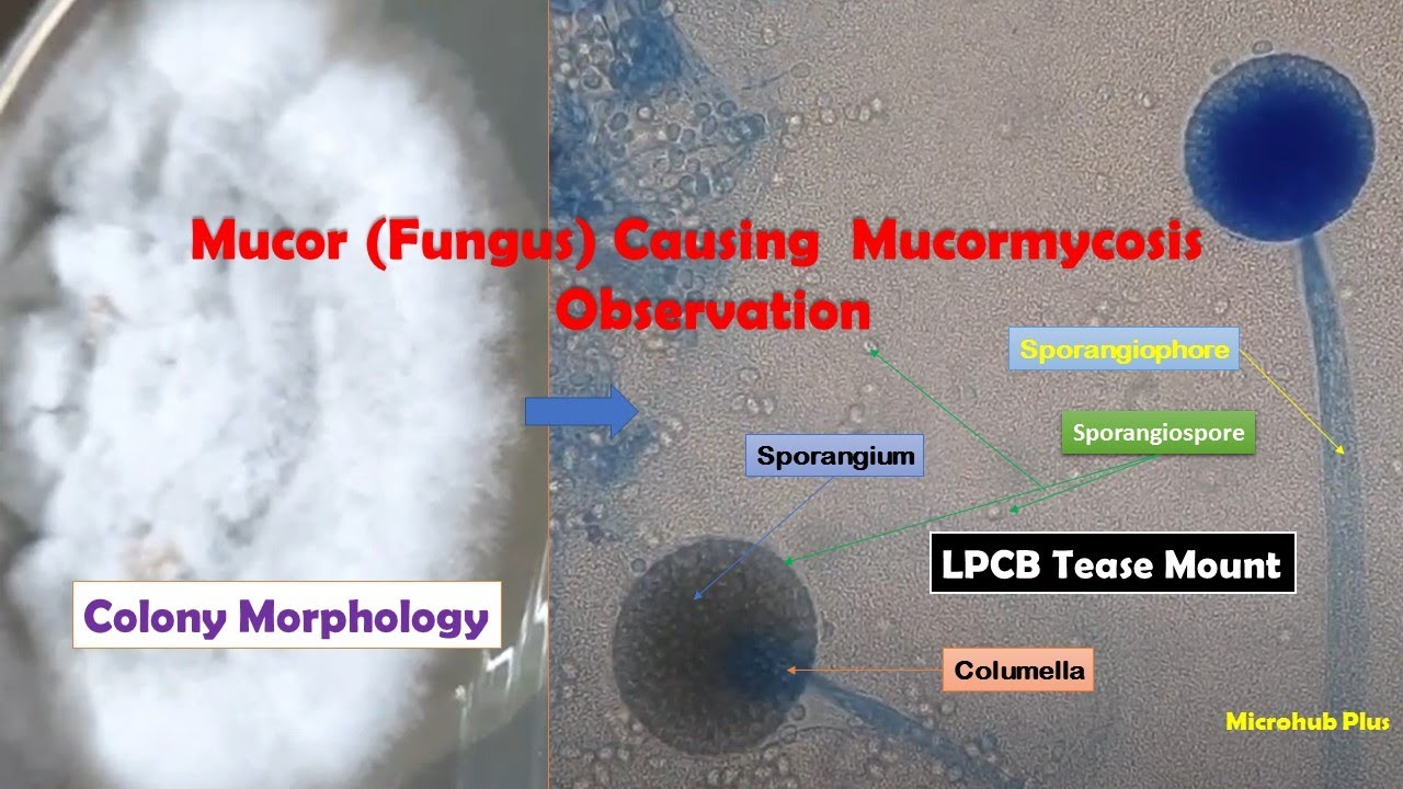Mucor causing Mucormycosis colony morphology and LPCB Tease Mount Microscopy