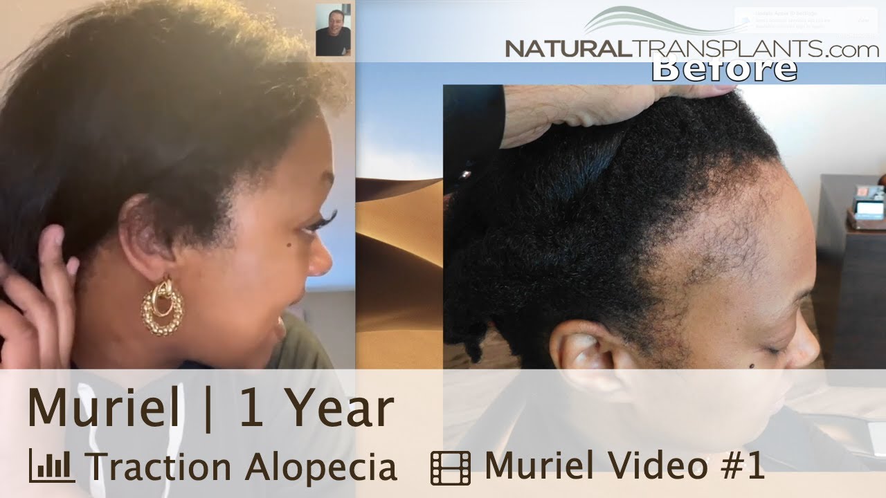 Get Your Edges Back Like Muriel - Hair Transplants for Black Females | Dr. Harold Siegel (Muriel)
