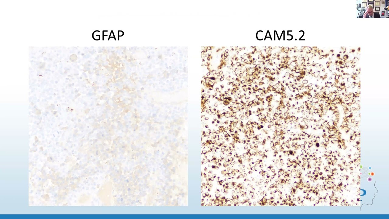 AANP Teaching Rounds - October 25, 2023 - DNA Methylation and Brain Tumors