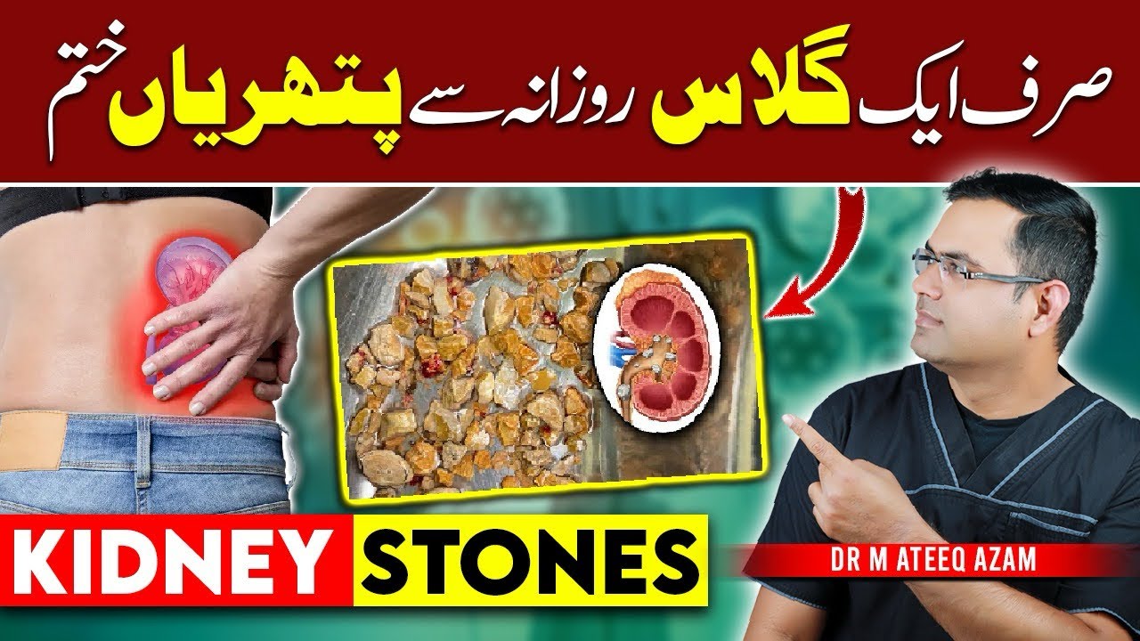# 1 Best Way to Prevent Kidney Stones | Kindey Stones ka ilaj