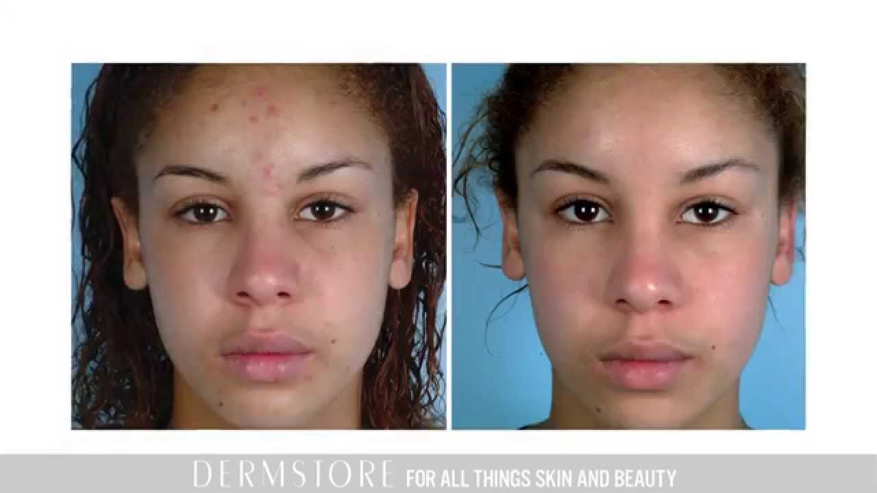 At Home Microdermabrasion with PMD Personal MicroDerm