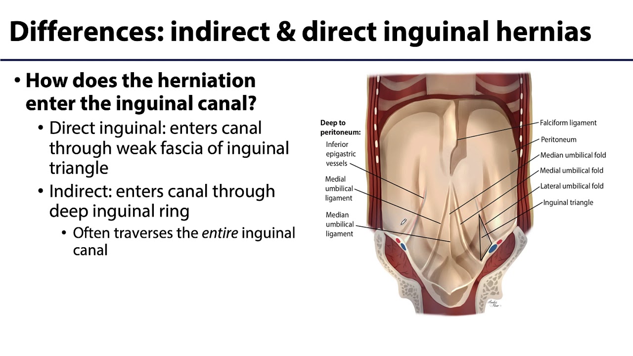 Inguinal Region, Peritoneum and Intestines LO3 - Inguinal Hernias