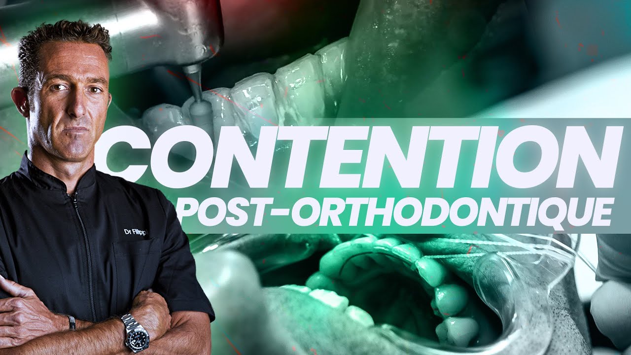 Comment coller un fil de contention post-orthodontique ?