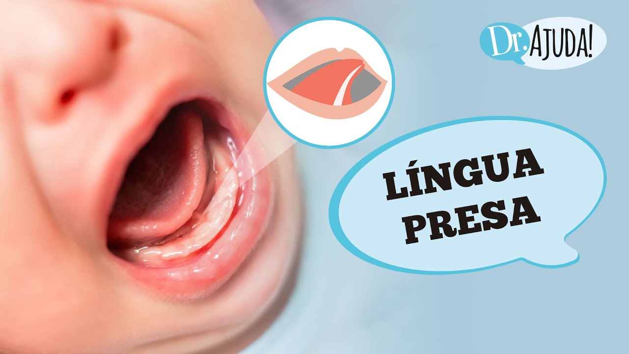LÍNGUA PRESA: O QUE É, IMPORTÂNCIA, SINTOMAS, COMPLICAÇÕES, DIAGNÓSTICO E TRATAMENTO