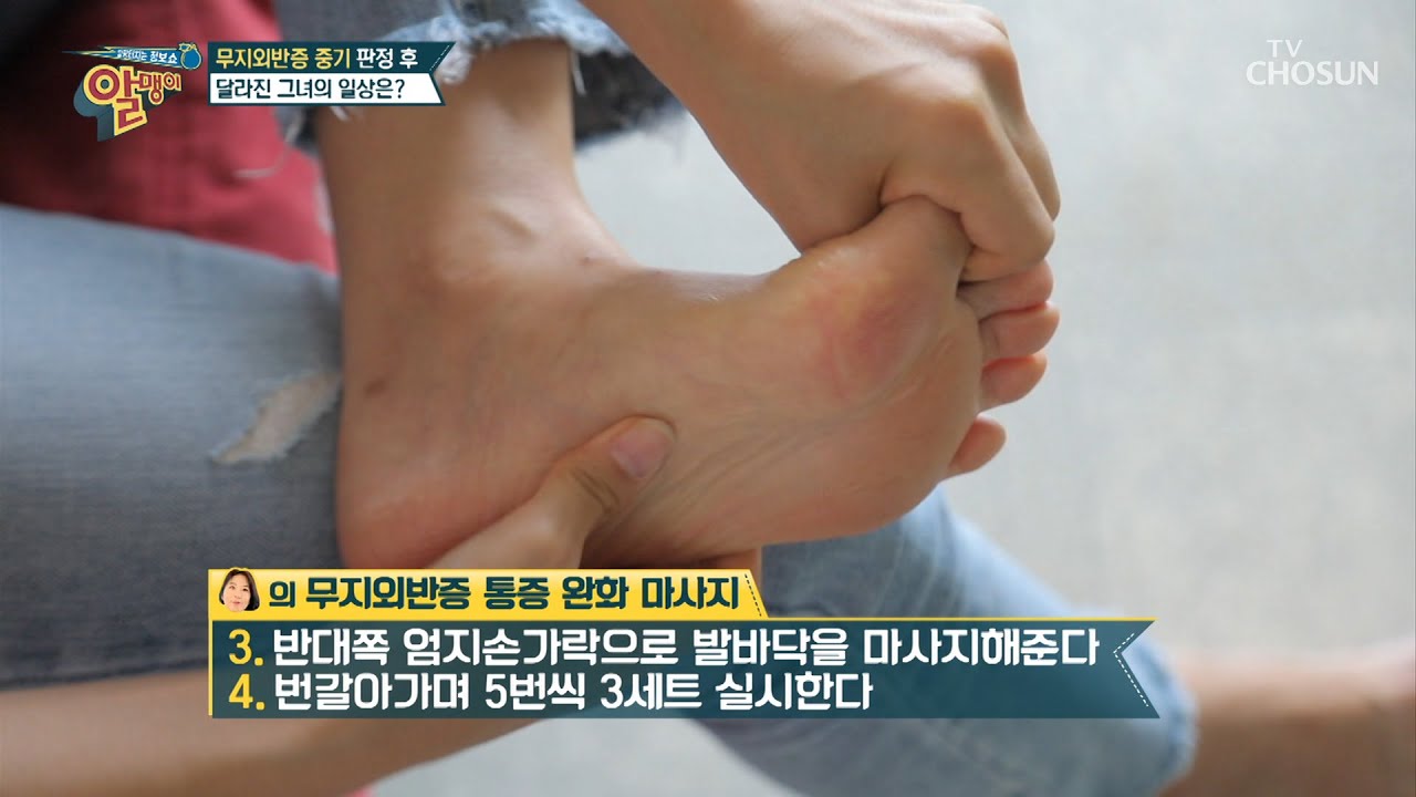 무지외반증 ✧운동법·마사지✧ 방법 공개!  [알맹이] 81회 20200712