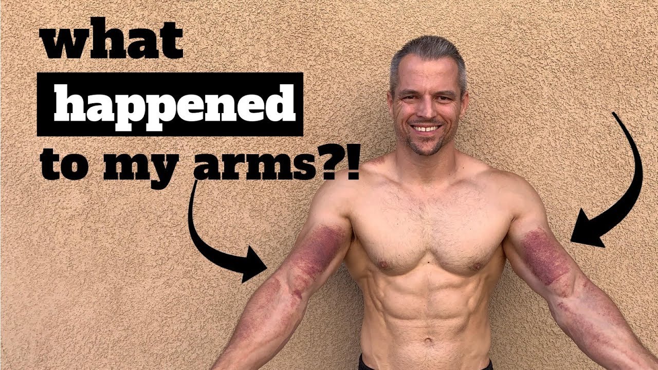 What happened to my arms?! Graston Technique to get my range of motion back!