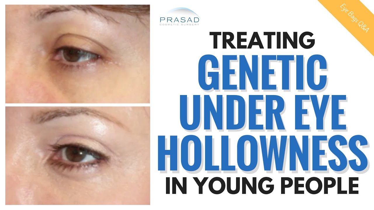 The Cause of Under Eye Hollowness in Young People, and How it Can be Treated