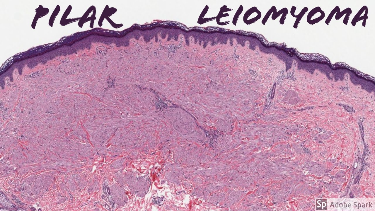 Leiomyoma, Pilar Type (Piloleiomyoma): 5-Minute Pathology Pearls