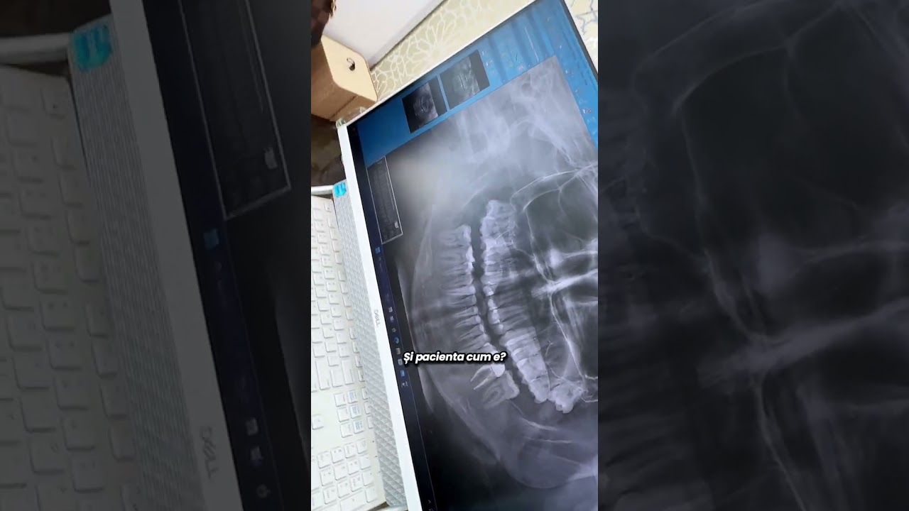 Extractia a doi molari de minte in aceeasi zi? 🫶🏼