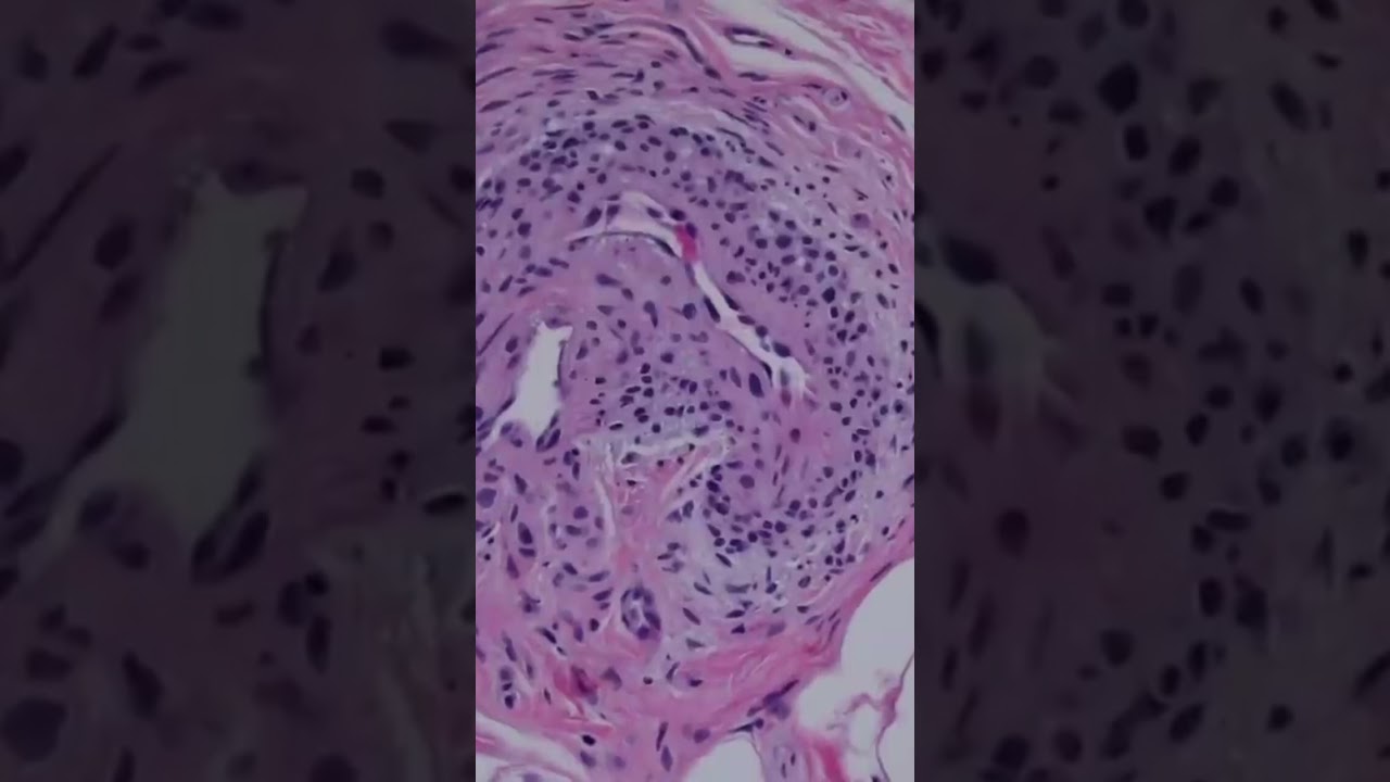 Prawidłowe ciało kłębuszkowe (kanał Sucqueta-Hoyera) pod mikroskopem. #Patologia #dermatologia #sk&oacute;ra #usmle
