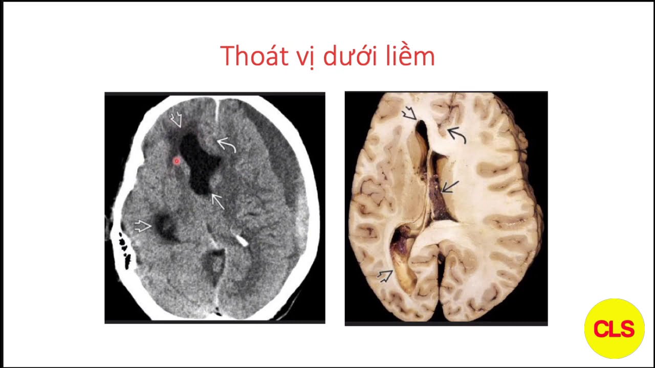 CT CHẤN THƯƠNG SỌ NÃO | TS. NGUYỄN THANH THẢO