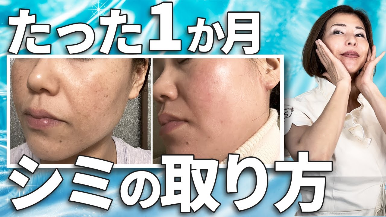 【症例】エンビロンで変わらなかったシミが、たった1か月で激変した理由