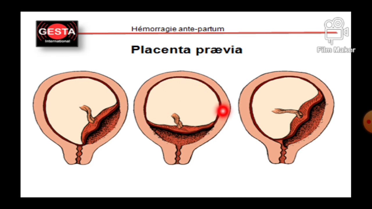 Placenta praevia (PPV)
