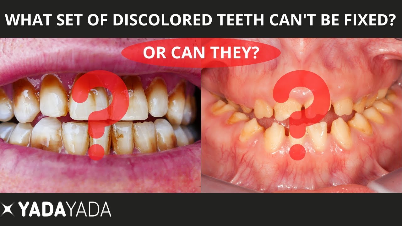 Stained teeth or bad genetics?  Can you fix discolored teeth?