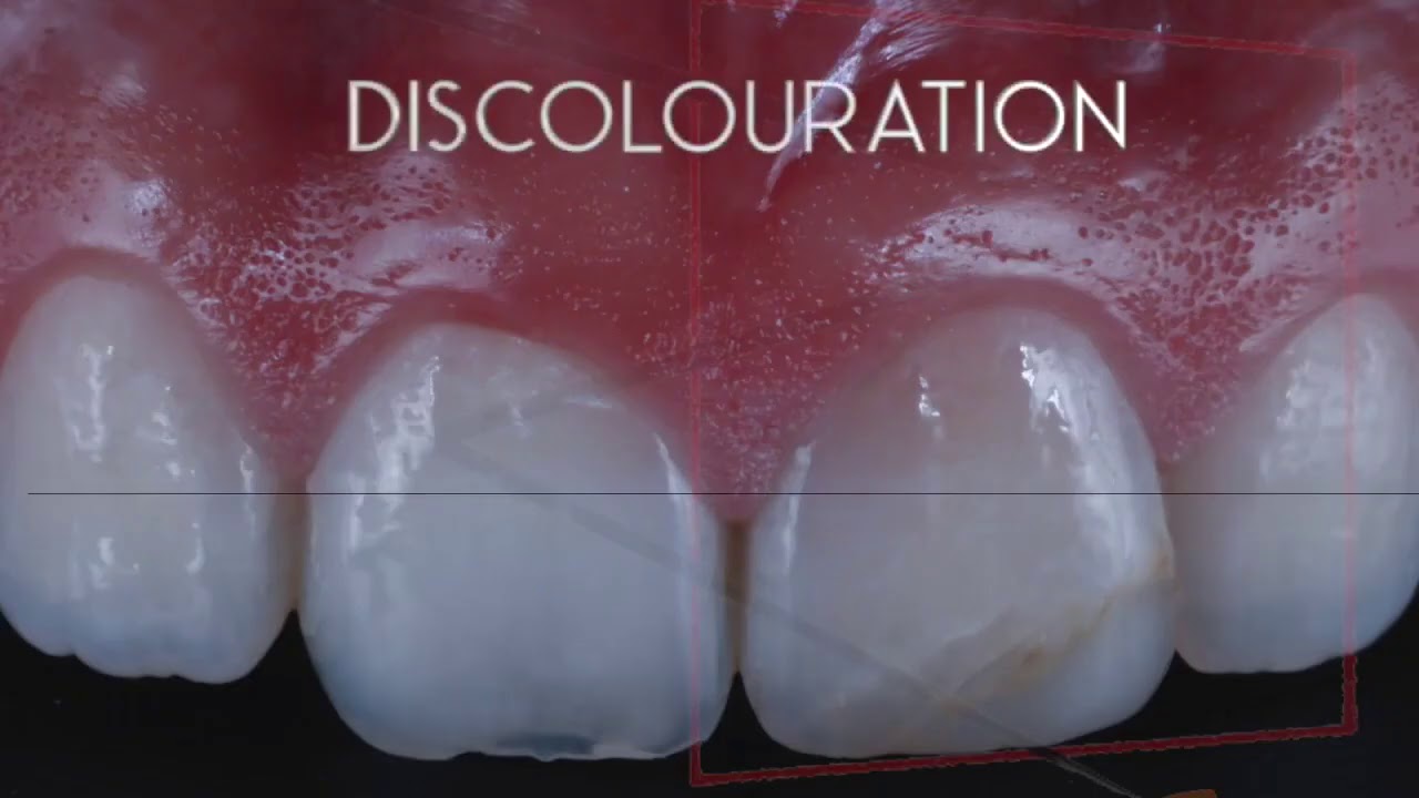 Video clinico restauro diretto anteriore del Dott. Alessandro Pezzana   #semplificalaqualitá