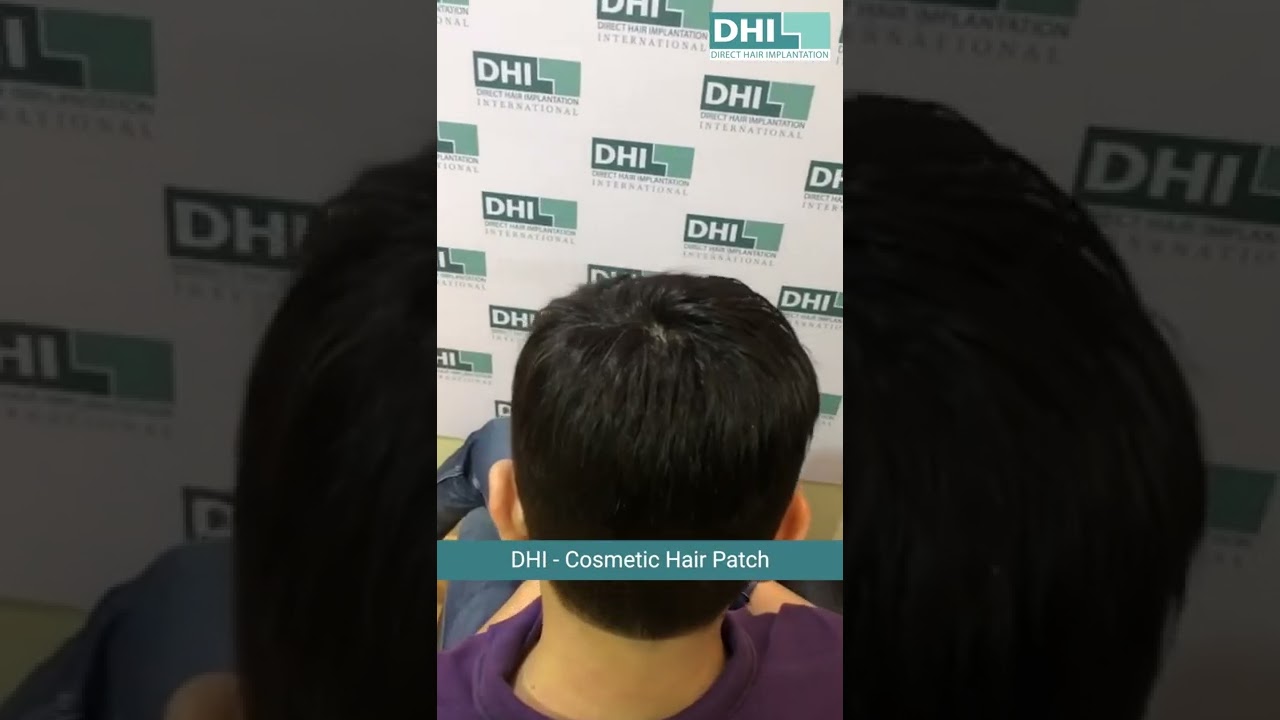 Non-Surgical Hair Treatment | HAIR PATCH | Direct Hair Fusion (DHF)