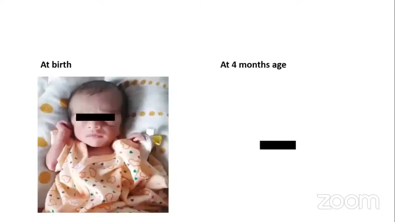 Pediatric Endocrinology for Postgraduates PEP March’23: Hypothyroidism