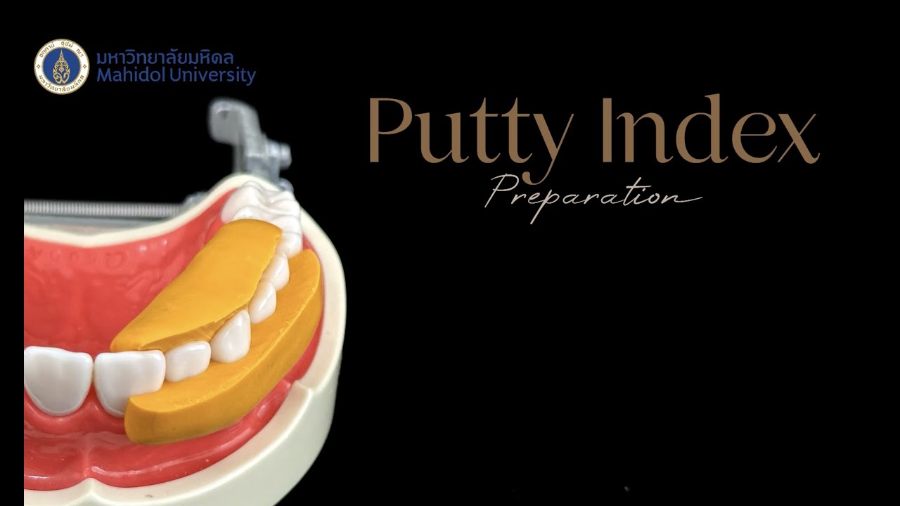 Putty index preparation for crown preparation