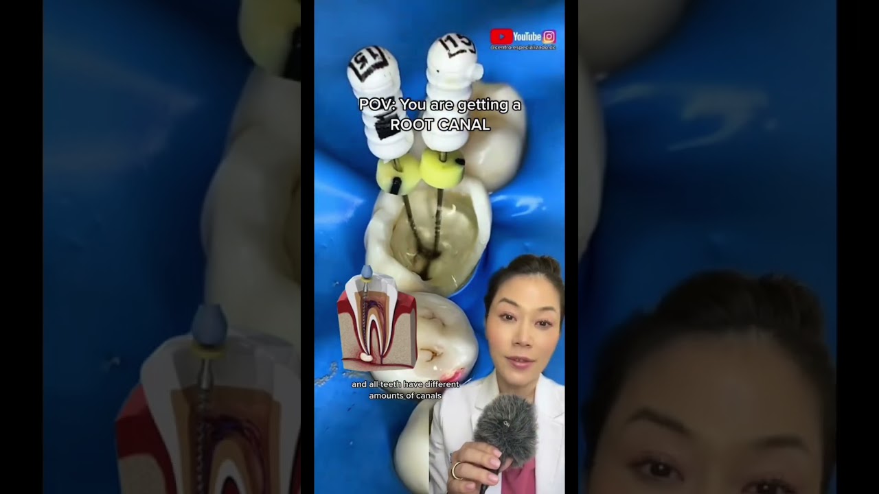 The files used on a root canal. #cavity #rootcanal #dentistry #files #dentalvideo