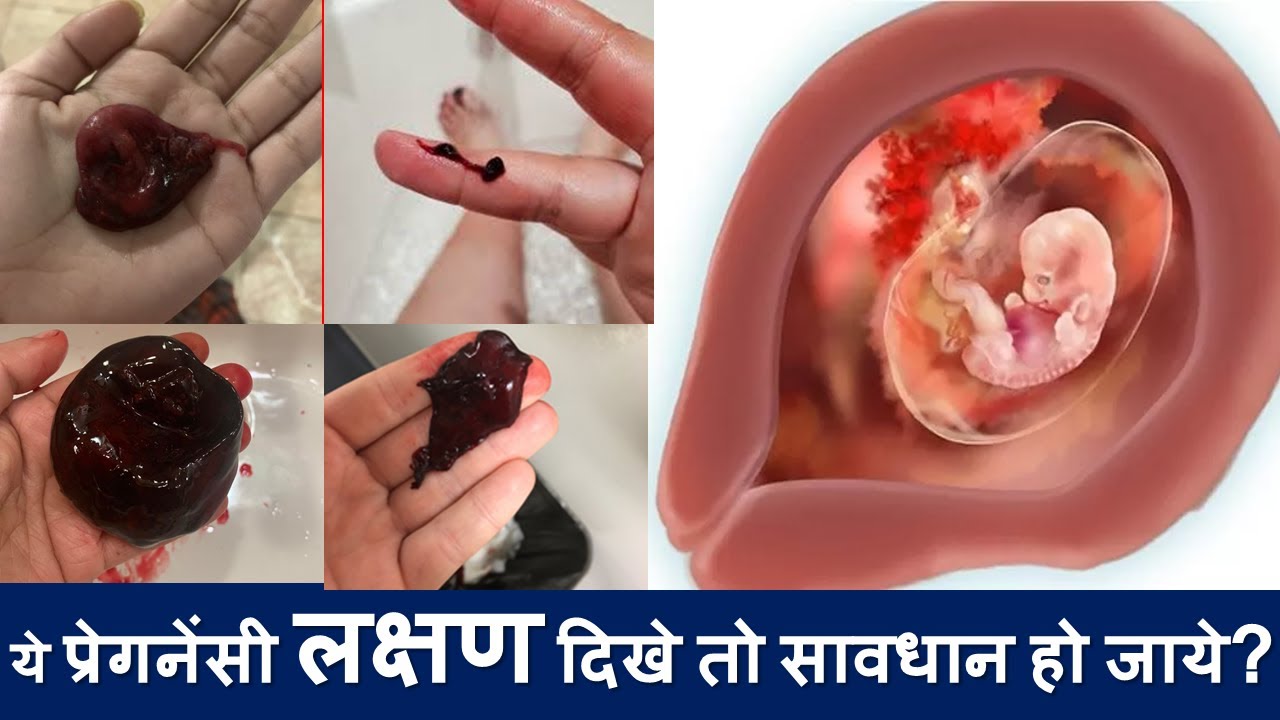 ये प्रेगनेंसी लक्षण दिखे तो सावधान हो जाये?  Ectopic pregnancy | Symptoms| Treatment