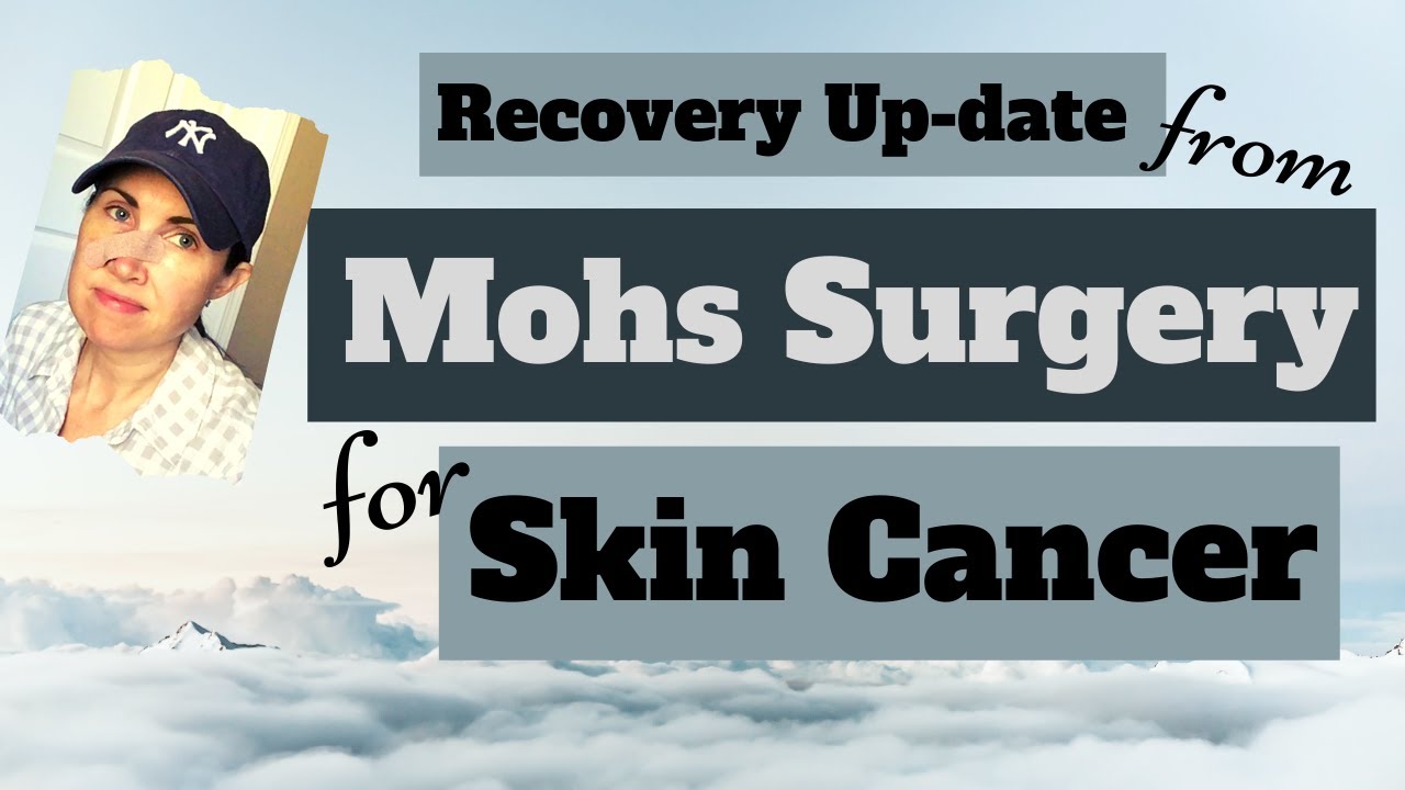 Mohs Surgery for Skin Cancer Recovery Up-date | My Mohs Surgery Experience & What to Expect After