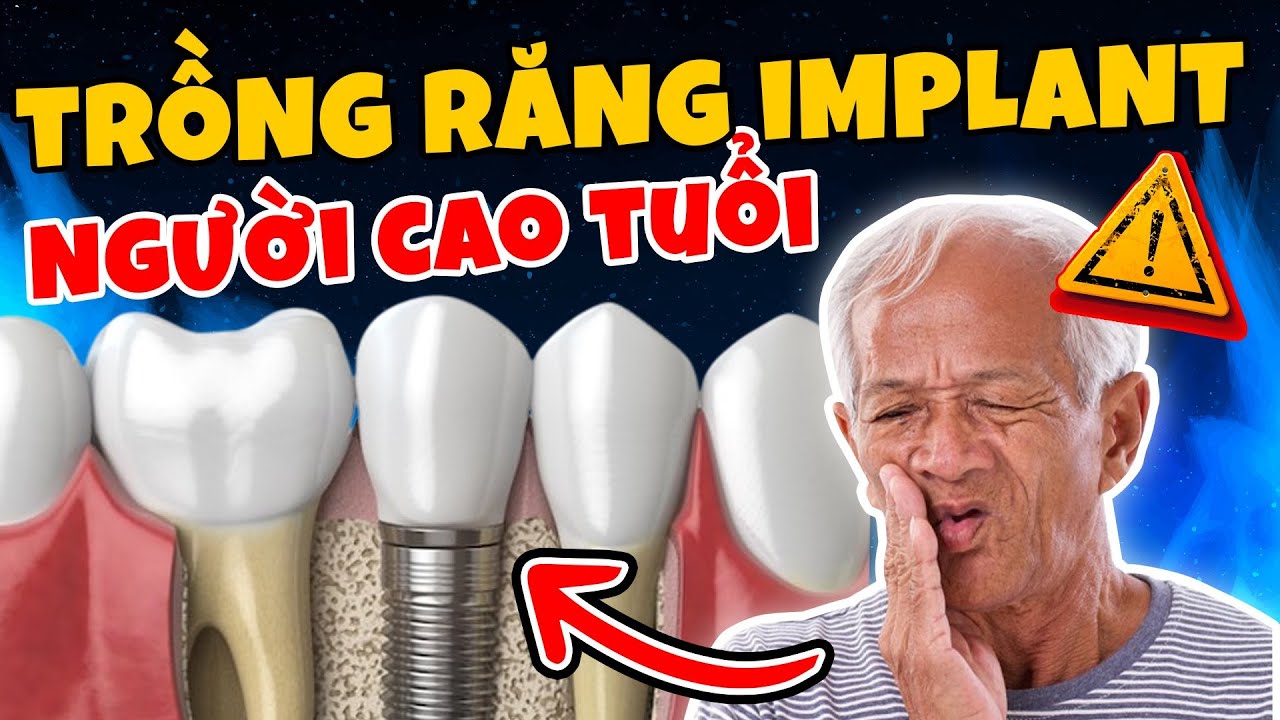 3 Lưu Ý Cực Quan Trọng Khi Trồng Răng Implant Cho Người Cao Tuổi (Liên Quan Trực Tiếp Đến Tính Mạng)