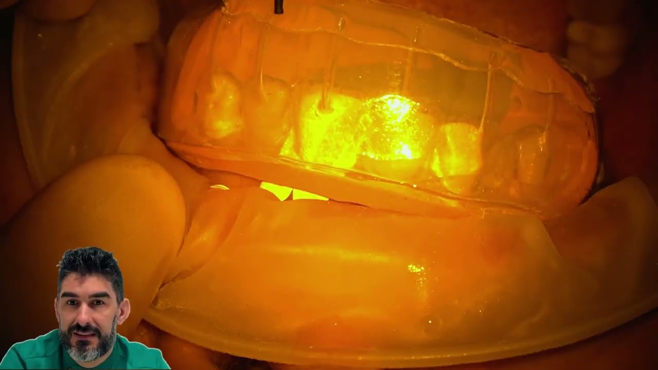 Scopri il Metodo M.I.I.T: Il Trattamento Estetico Dentale Rapido e Non Invasivo | Microdent Bologna