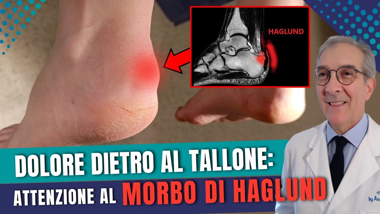 Protuberanza al tallone e dolore? Scopri il Morbo di Haglund | Dott. Andrea Scala