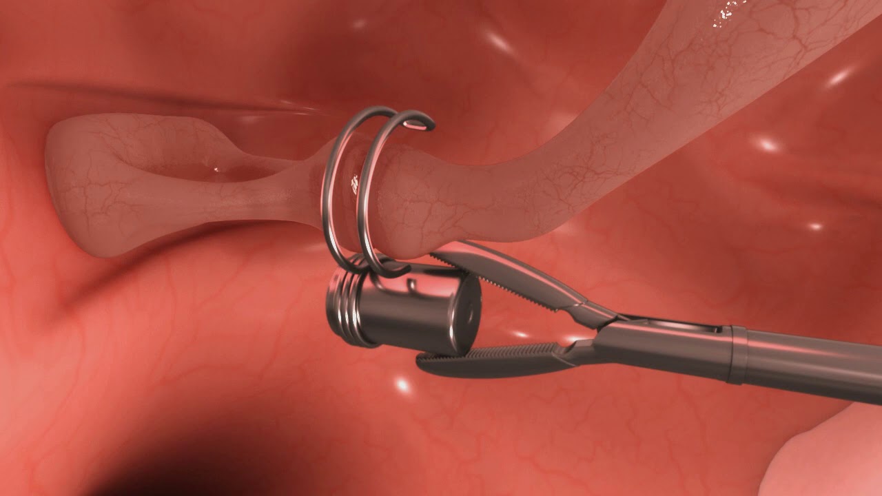 MAXUM Implant