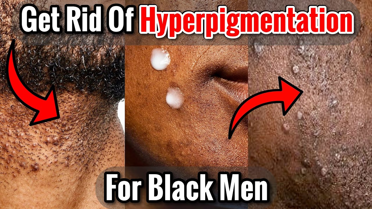 How to Get Rid of Hyperpigmentation From Shaving for Black Men