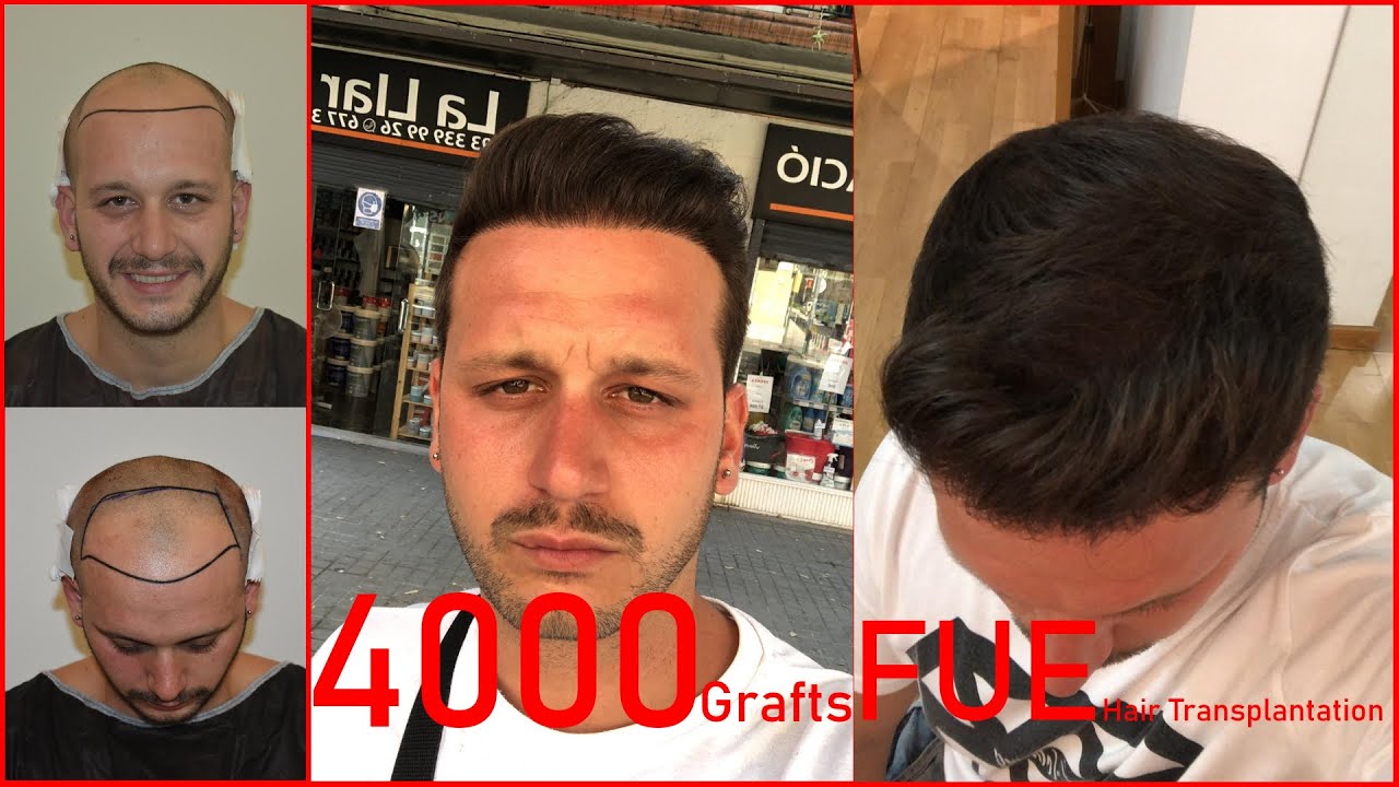 Successful FUE Technique Hair Transplant / Injerto Capilar Exitoso con La Técnica FUE