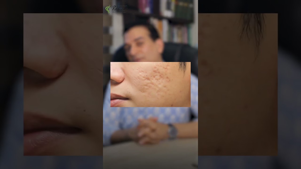 Best Acne Scar Treatment in Jaipur | Radiant Skin and ENT Clinic #drvishalchugh #jaipur #acnescars