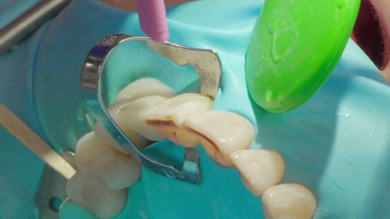 Visalys&reg; Fill composiet facings door tandarts Han van de Sande