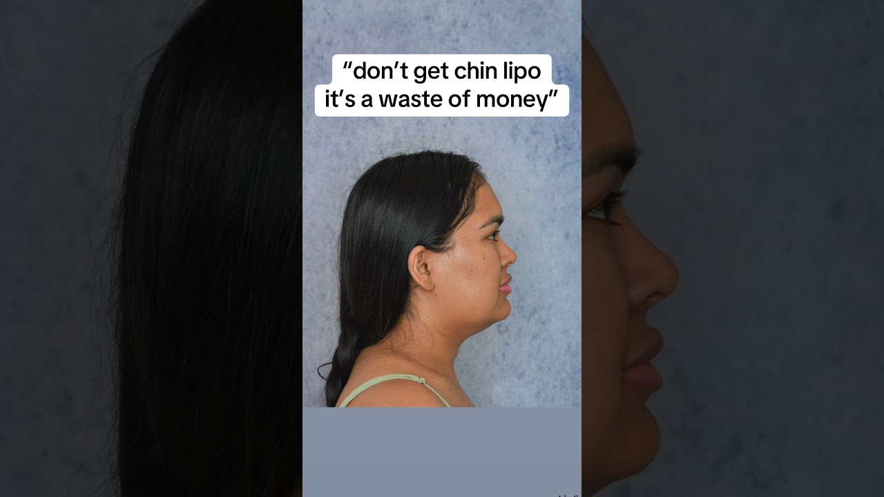 INSANE chin lipo results 😱🔥 #chinlipo #chinliposuction #plasticsurgery #glowup #jawline #snatched