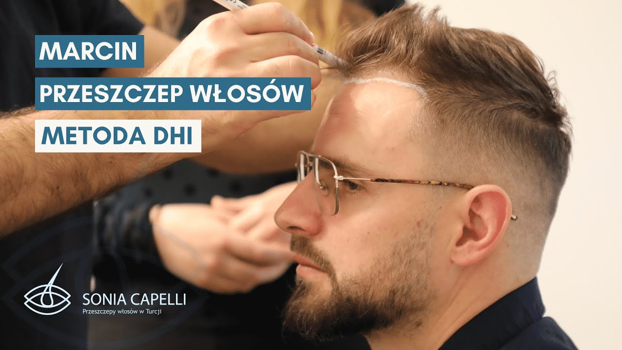 Marcin i przeszczep włosów w Turcji | Sonia Capelli