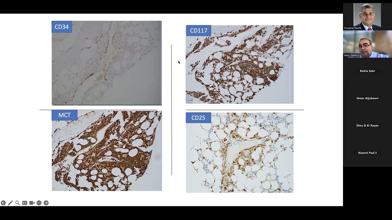 Dr. Hany Meawad – Mast Cell Disease: An Overlooked Entity