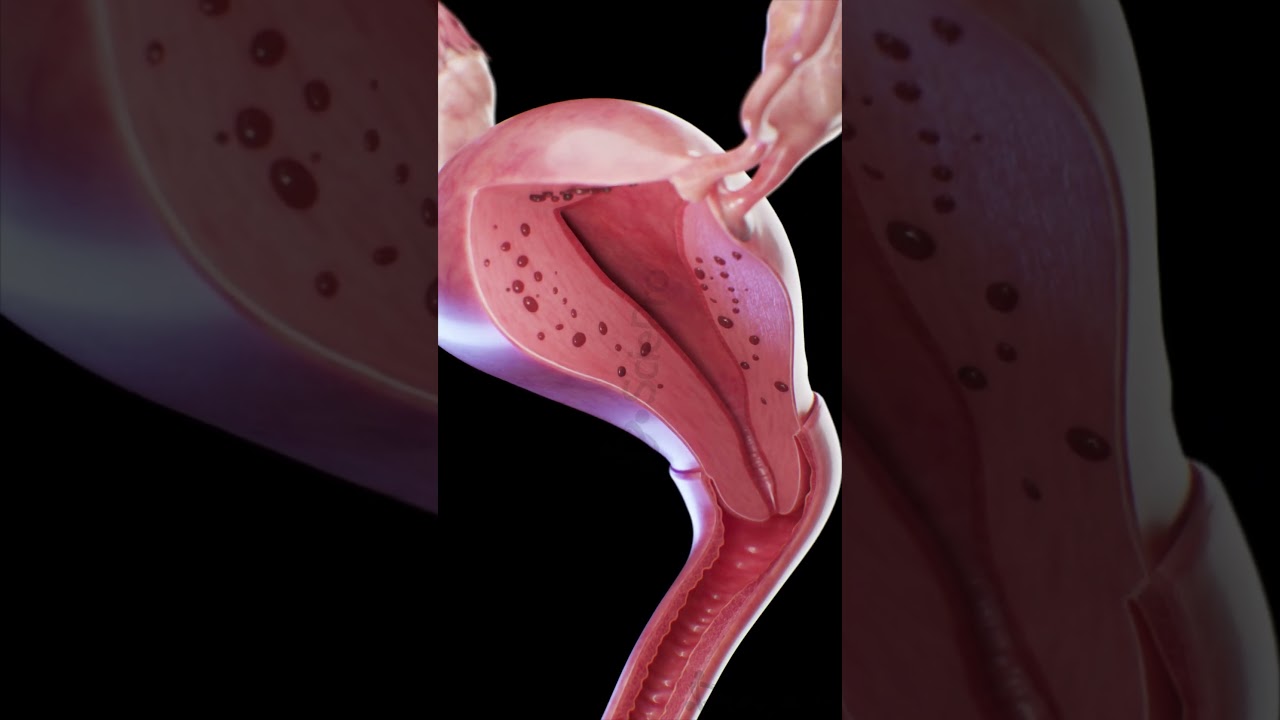 Adenomyosis | 3D Uterus Animation