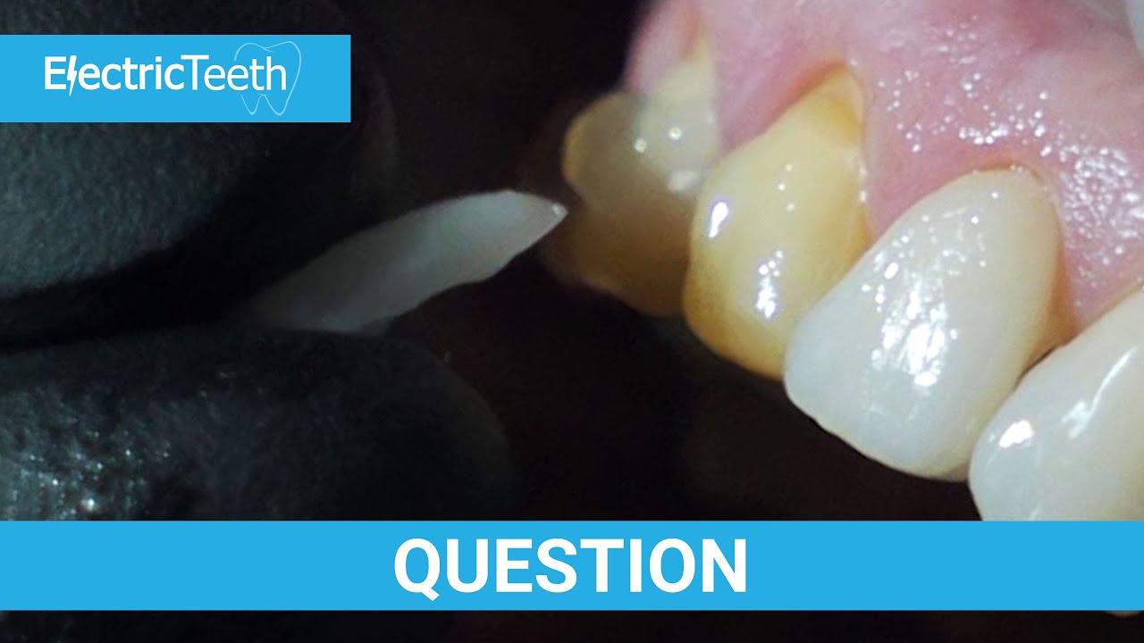 Do veneers stain & can you whiten your veneers?