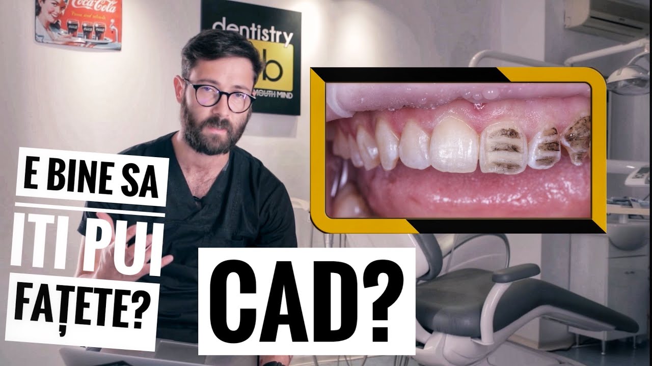Cum Se Pun CORECT Fațetele Dentare