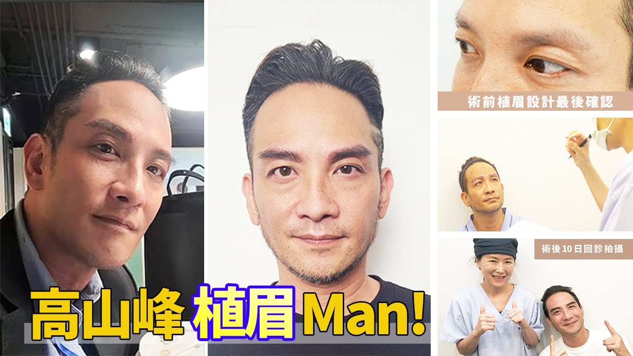 植眉!藝人高山峰的唯一選擇【ABHRS*植髮*植眉*植鬍權威 林宜蓉醫師】台灣林宜蓉醫師 Dr. Yi Jung Lin 高地植髮家知識講堂