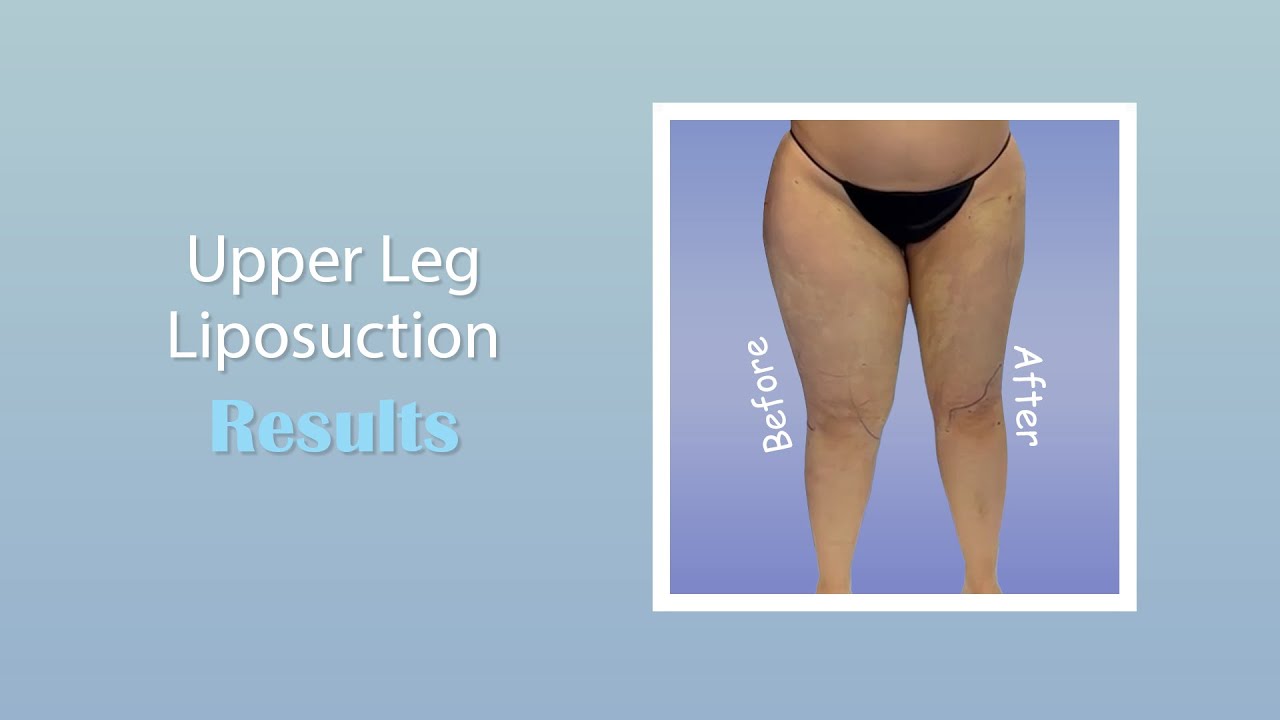 Thigh & Knee Liposuction | Lipedema Surgery | Immediate Results | Expert Dr. Thomas Su