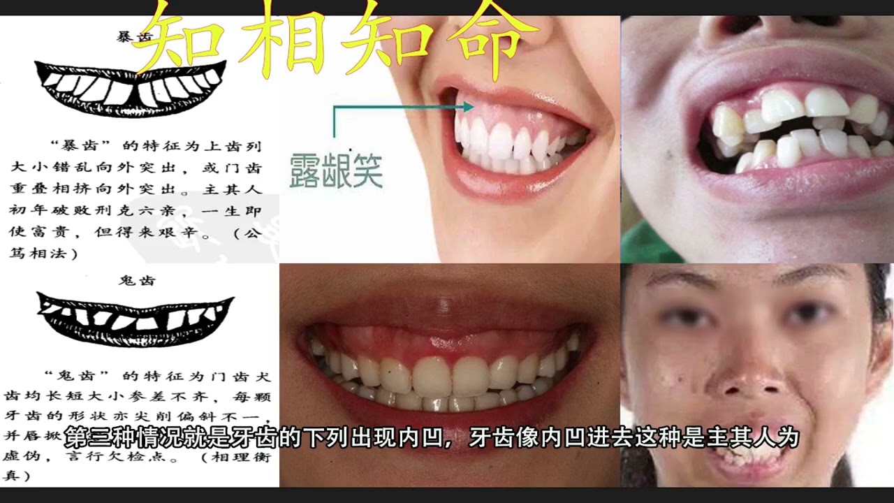 面相之齿相系列之三，笑露牙龈，牙齿内凹，爆牙的含义