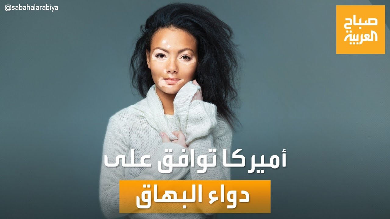 صباح العربية| تفاصيل موافقة أميركا على أول دواء منزلي لعلاج البهاق