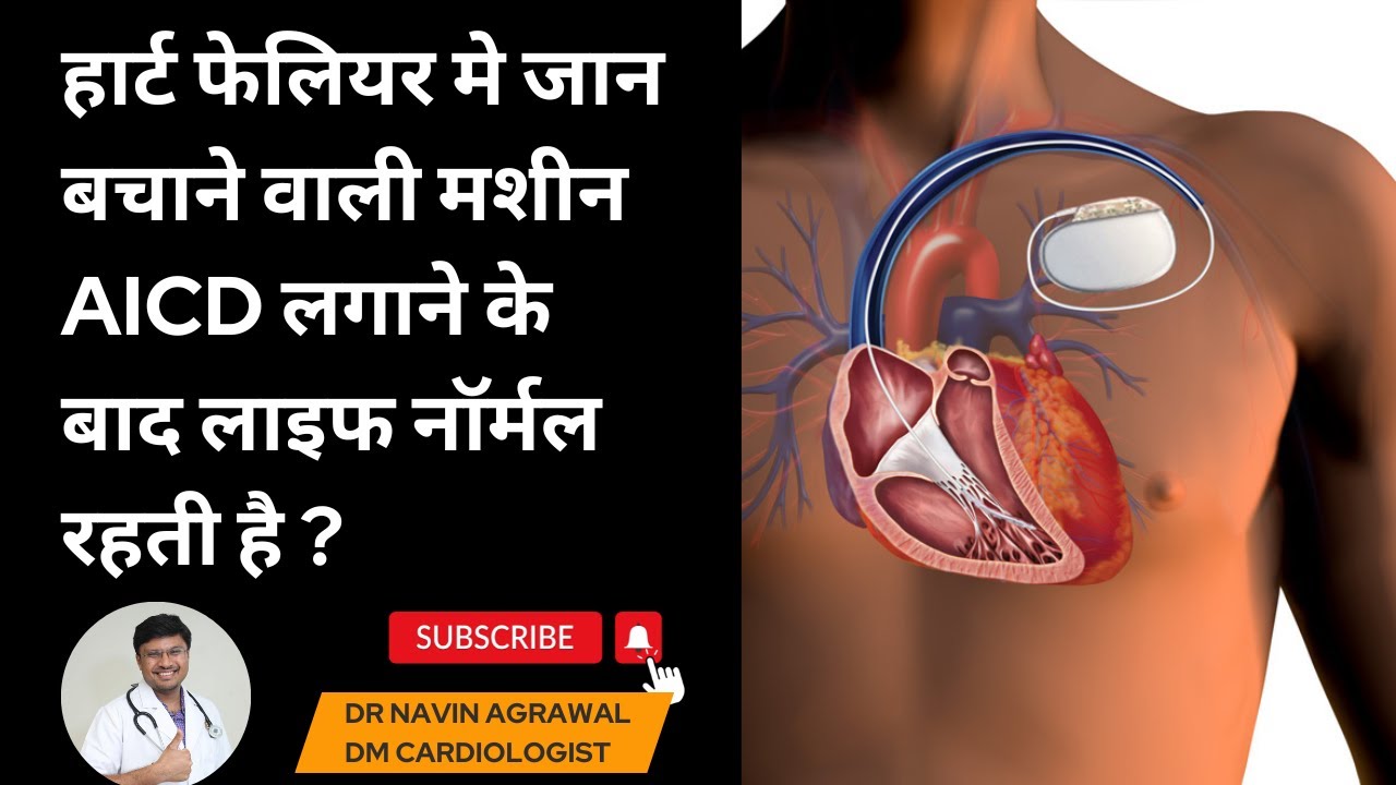 AICD/Defibrillator device:A Guide to AICD Implantation in heart failure