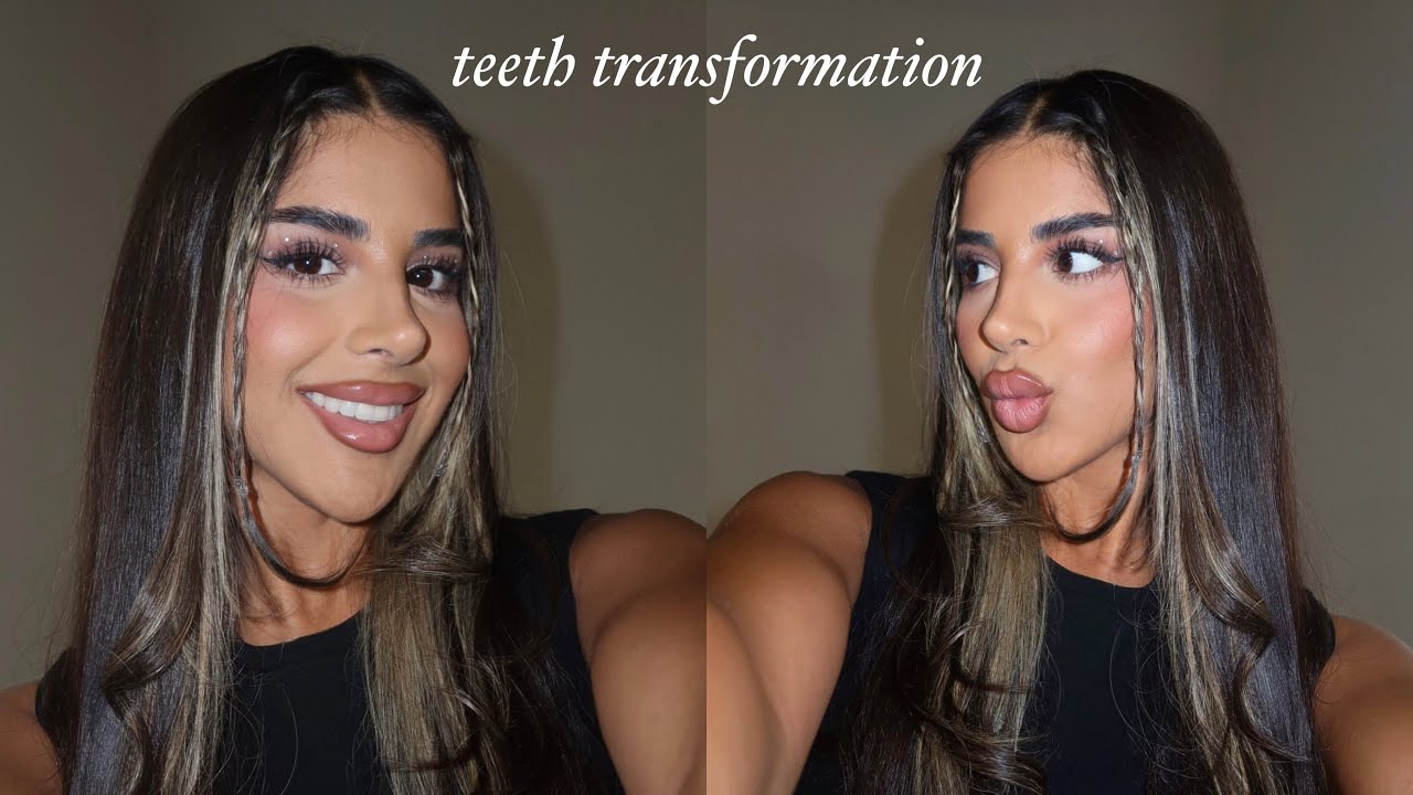 MY TEETH TRANSFORMATION... Invisalign, whitening + composite edge bonding