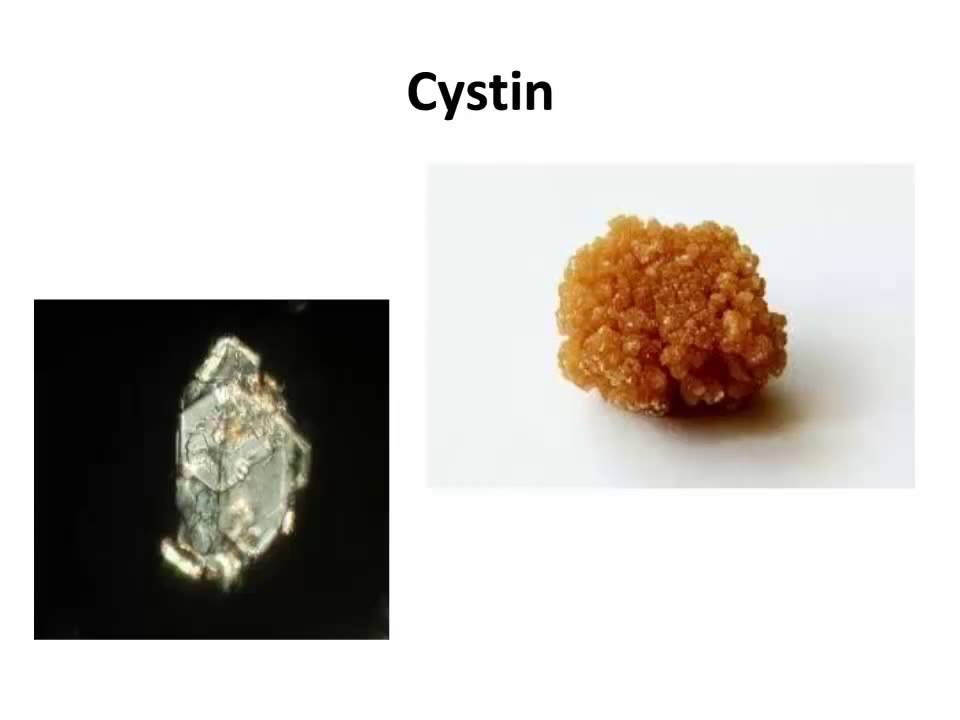 Analýza močových konkrementů