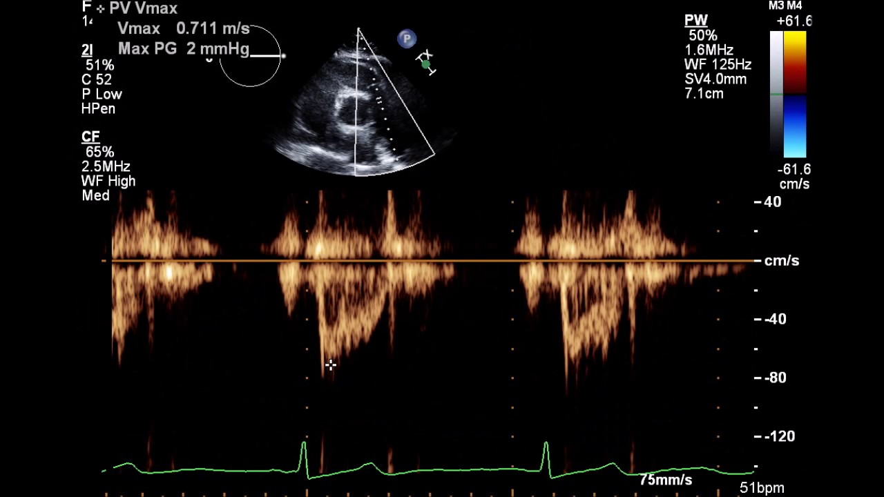 Normal Complete 2D Echocardiogram with Color Doppler and Spectral Doppler