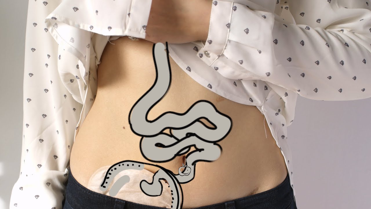 Gutsy: A documentary about living with IBD
